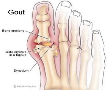 Bệnh Gút Là Gì?
