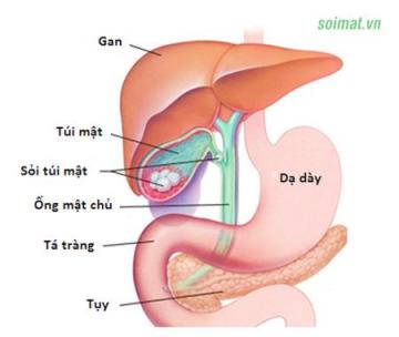 Sỏi mật và phụ nữ